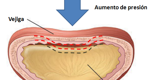La miel con la canela de la osteocondrosis